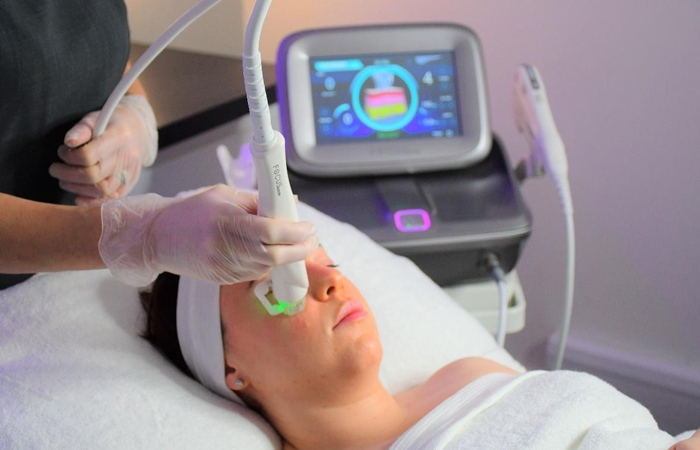 Radio Frequency Microneedling