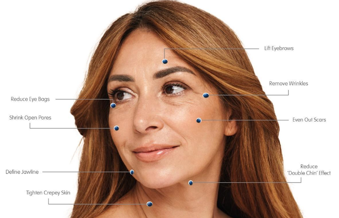 Microneedling