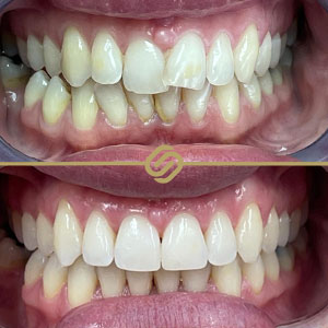 Invisalign Case