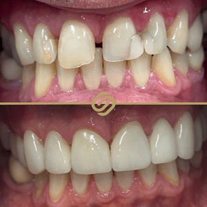 Invisalign Case