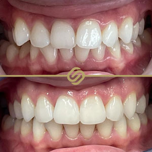 Invisalign Case