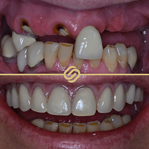 Dental Implant Case