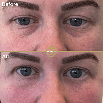 before after anti wrinkle