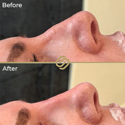 before after anti wrinkle