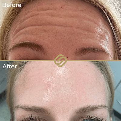 before after anti wrinkle