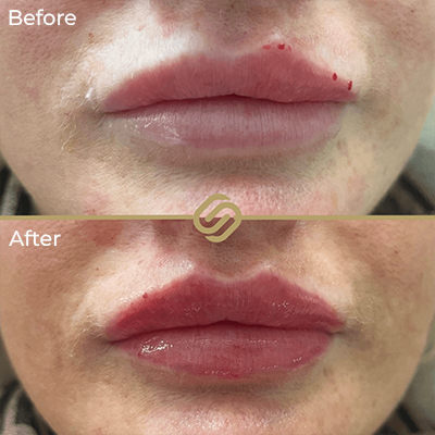 before after anti wrinkle