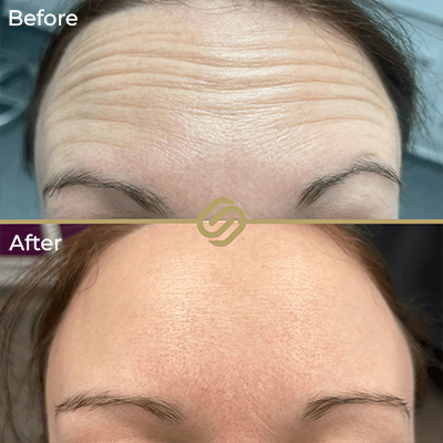 before after anti wrinkle