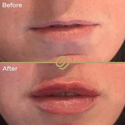 before after anti wrinkle