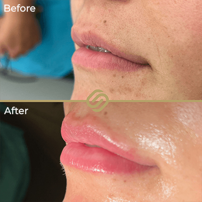 before after anti wrinkle