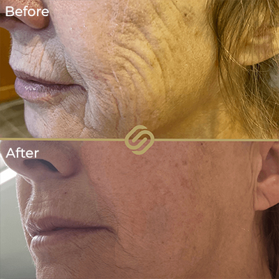 before after anti wrinkle