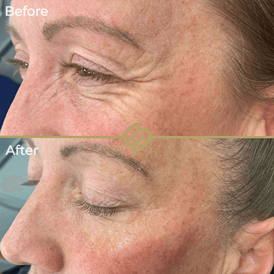 before after anti wrinkle
