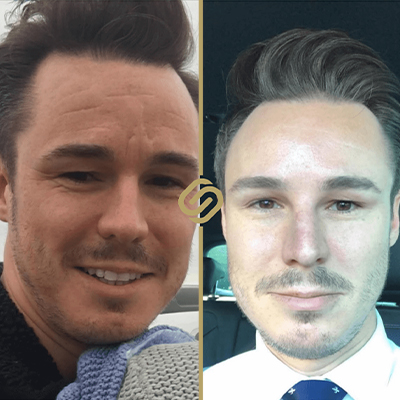 before after anti wrinkle