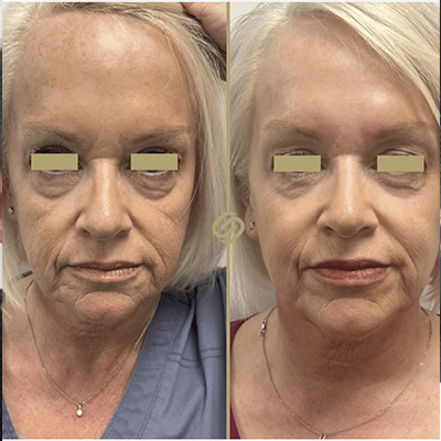 before after anti wrinkle