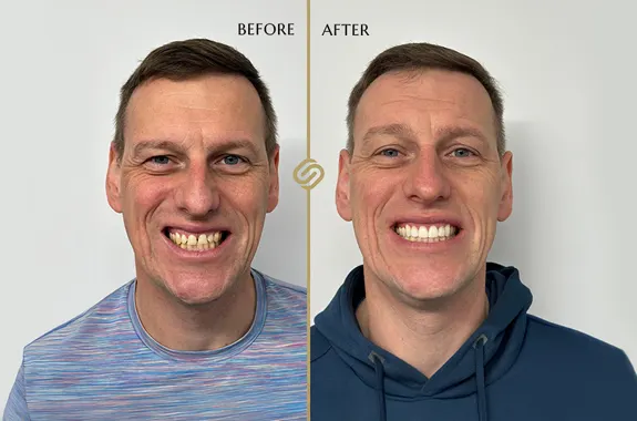 Free Invisalign Consultations