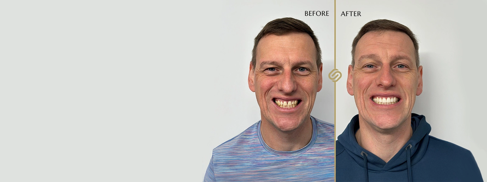 Free Invisalign Consultations