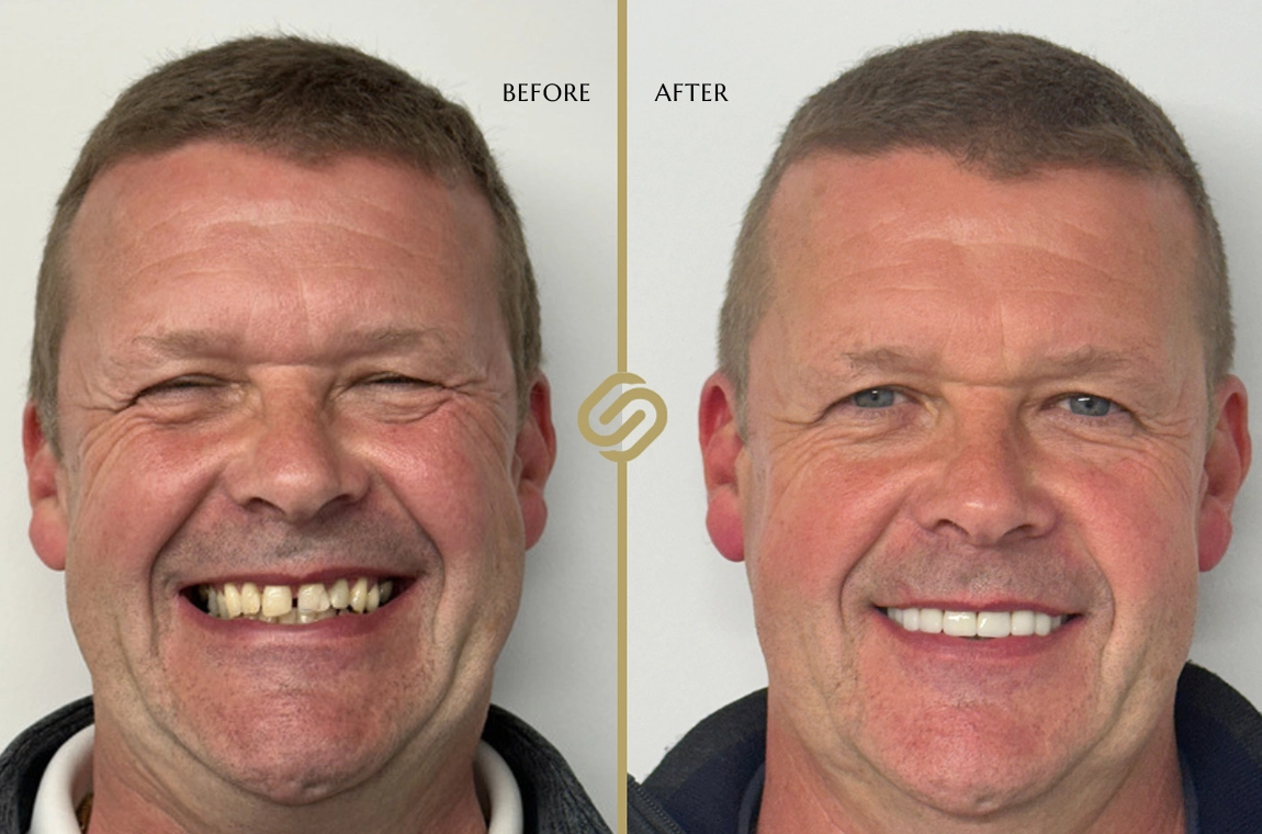 Free Invisalign Consultations