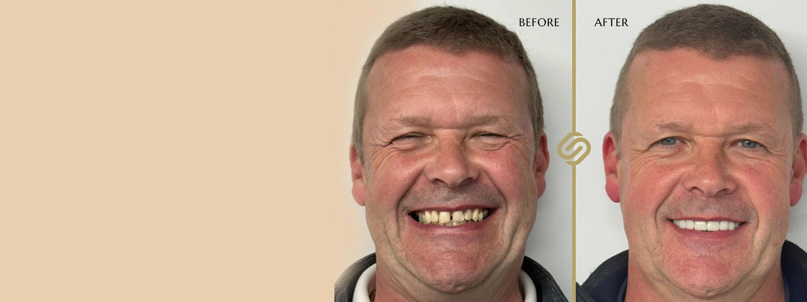 Free Invisalign Consultations